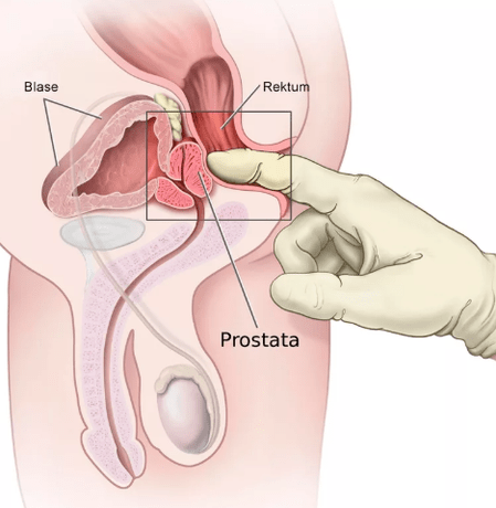 Masaż prostaty