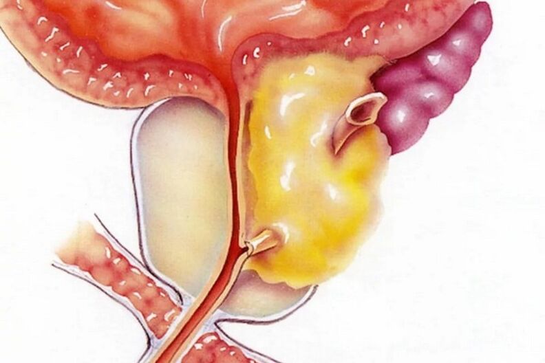 Zapalenie prostaty